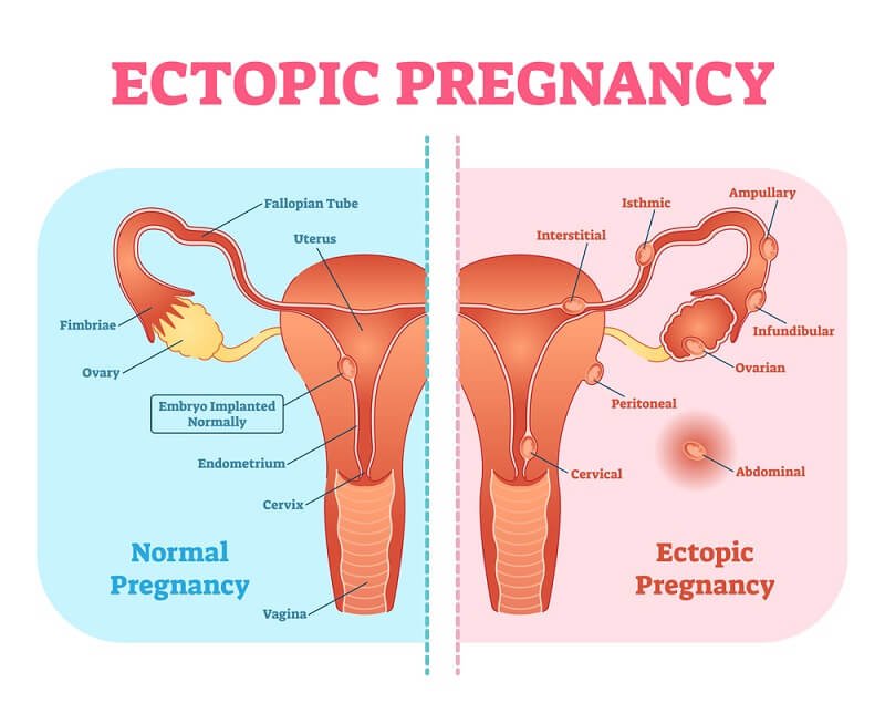 Concept about Ectopic pregnancy