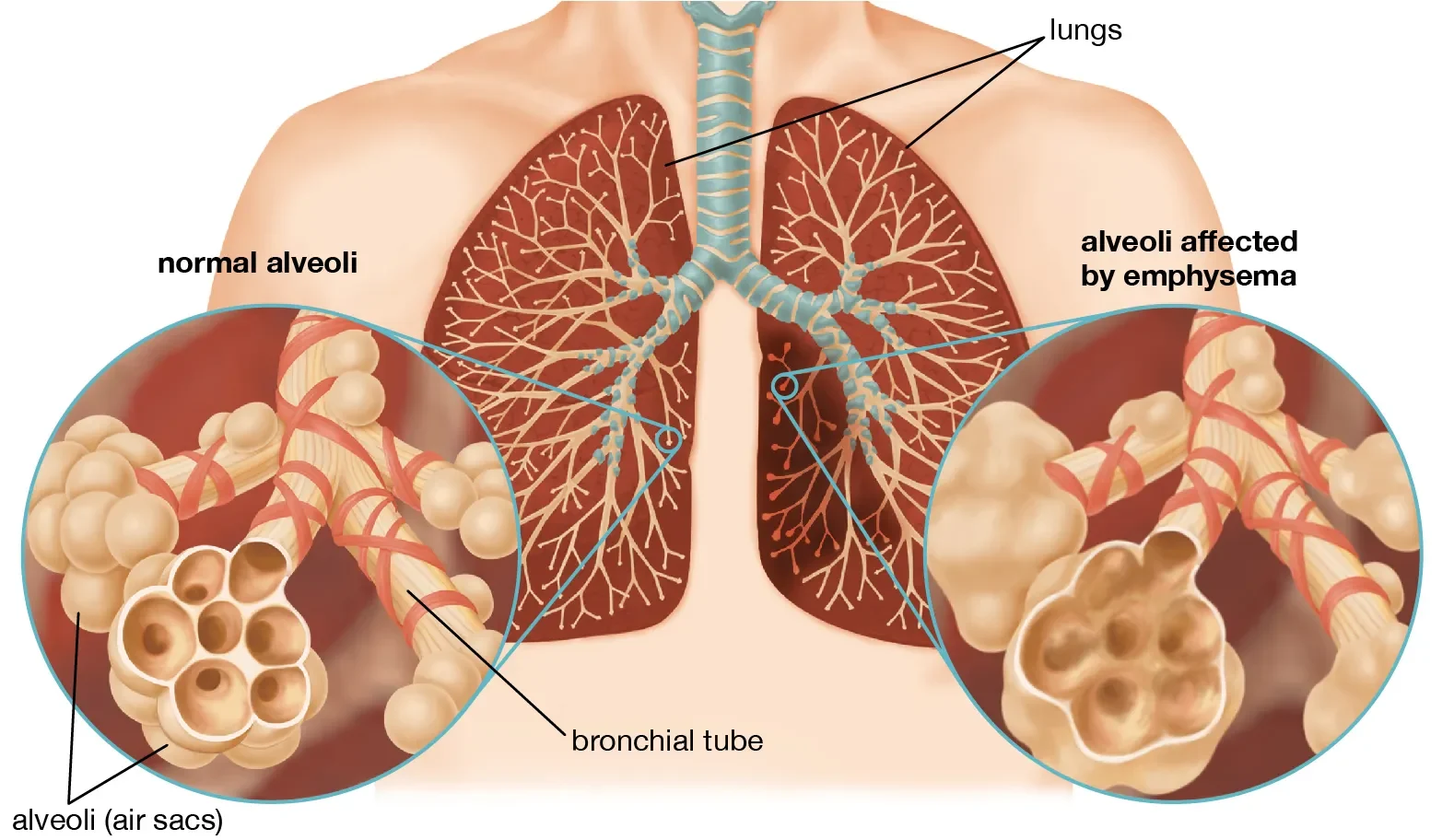 Respiratory Disease | Chapter 12 | Midwifery For Diploma In Nursing