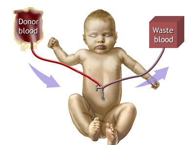 Exchange transfusion