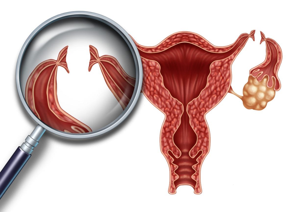 Female sterilization and MR (menstrual regulation)