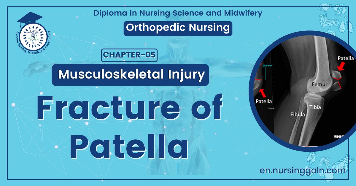 Fracture of Patella | CHAPTER 5 | Orthopedic Nursing