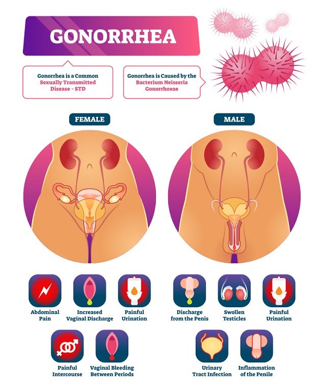 Definition of Gonorrhea | Chapter 12 | Midwifery For Diploma In Nursing