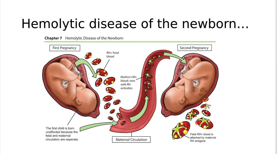 Hemolytic disease of the newborn | CHAPTER 18 | Pediatric Nursing