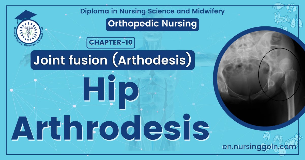 Hip Arthrodesis | CHAPTER 10 | Orthopedic Nursing