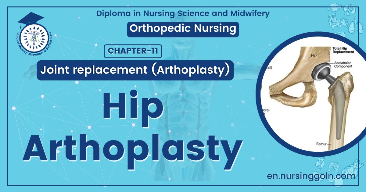 Hip arthoplasty | CHAPTER 11 | Orthopedic Nursing