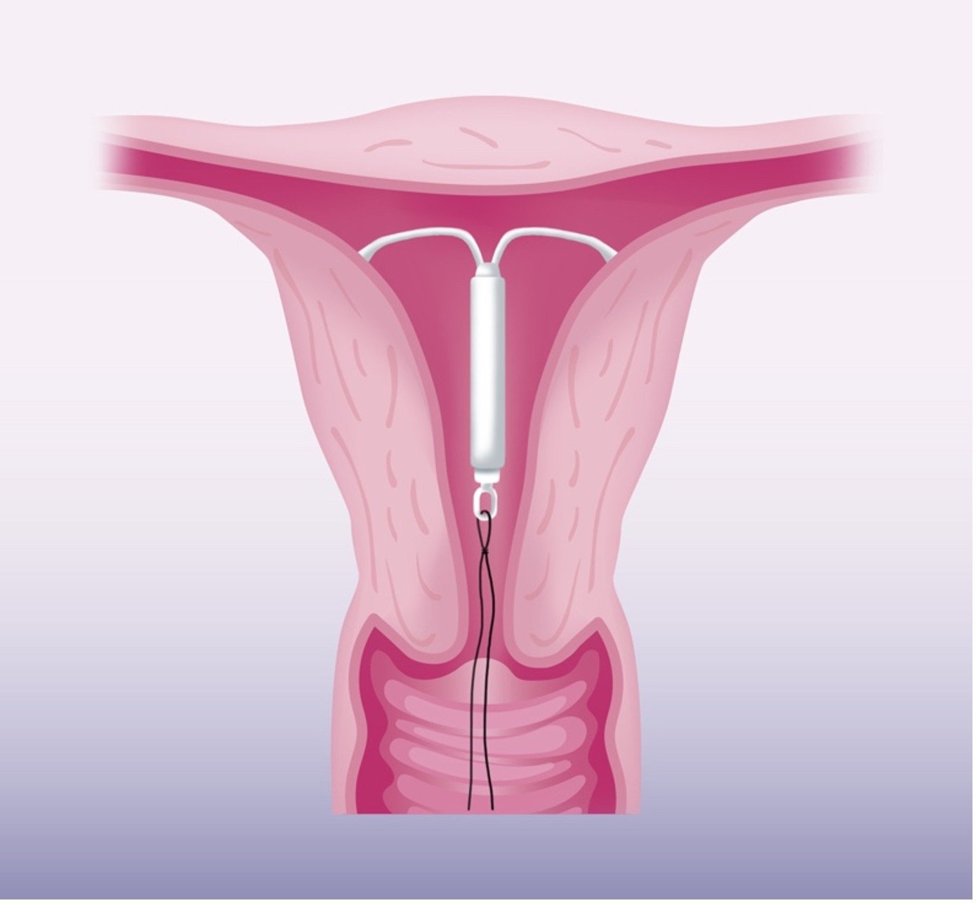 Concept About IUCD | CHAPTER-17 | Pharmacology
