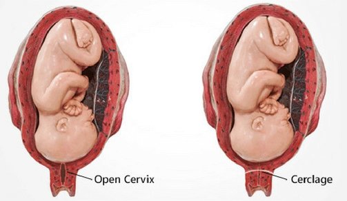 Cervical Incompetence | Chapter 17 | Midwifery For Diploma In Nursing