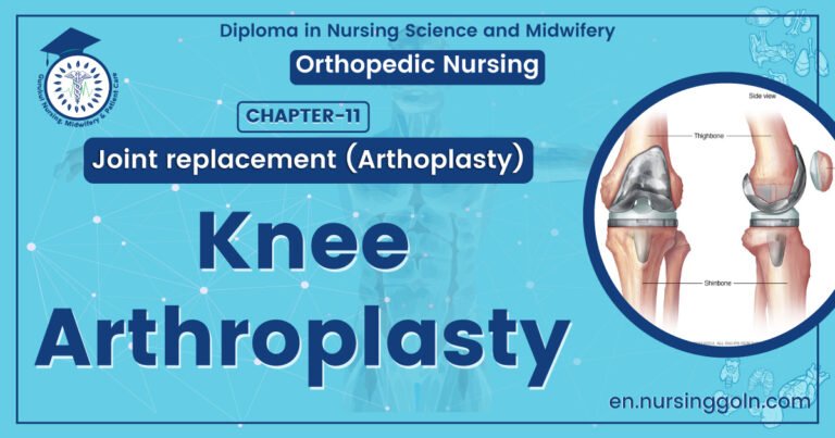 Knee Arthroplasty | CHAPTER 11 | Orthopedic Nursing