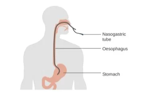 Concept of Nasogastric Tube | CHAPTER 8 | Nutrition and Dietetics