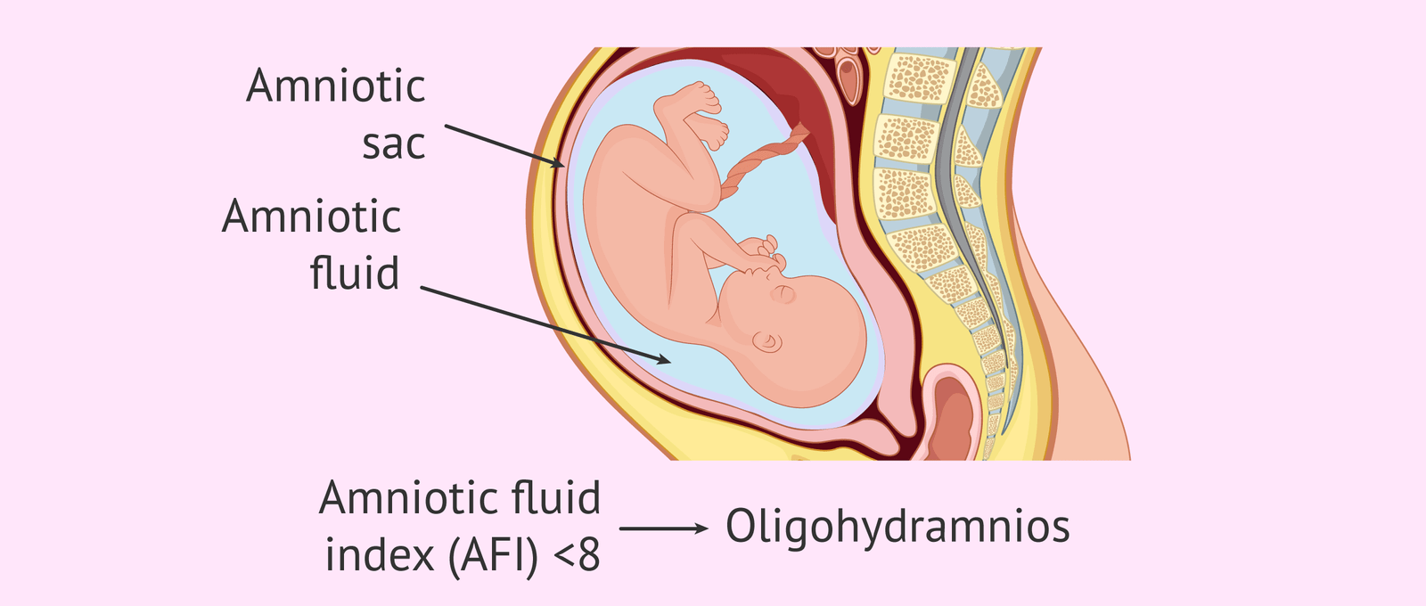 Concept about Oligohydramnios