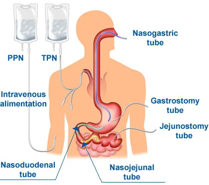 Parenteral Nutrition