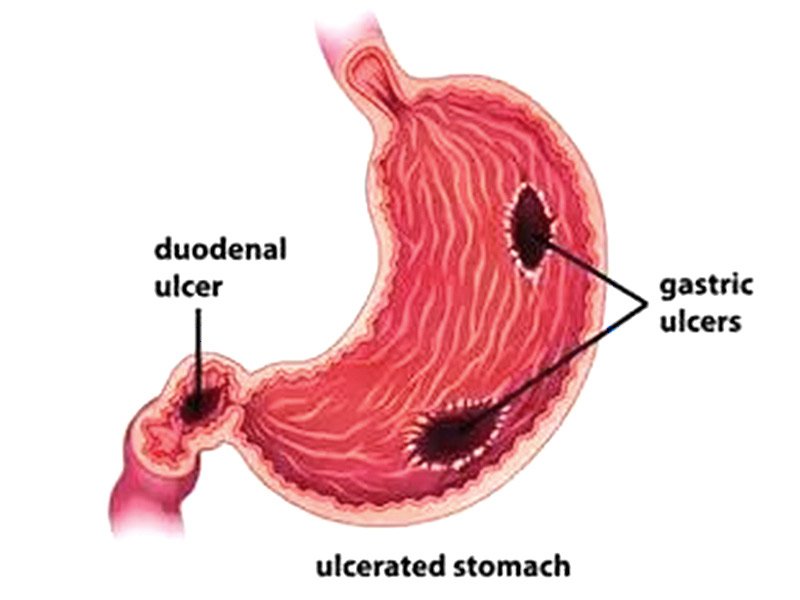 Concept of Peptic Ulcer Disease (PUD) | CHAPTER-8 | Pharmacology