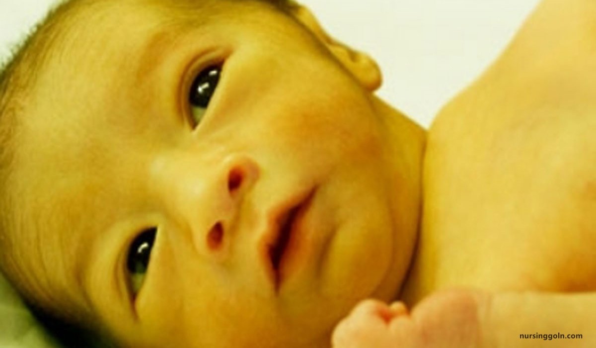 Physiological jaundice | CHAPTER 18 | Pediatric Nursing