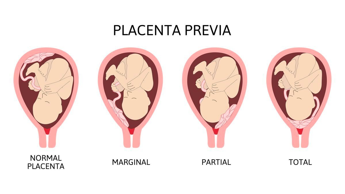 Concept about Placenta praevia