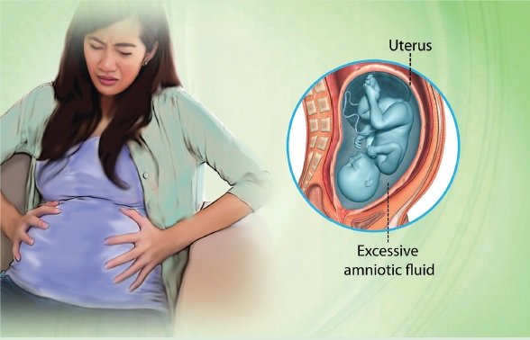 Abnormal hydramnios