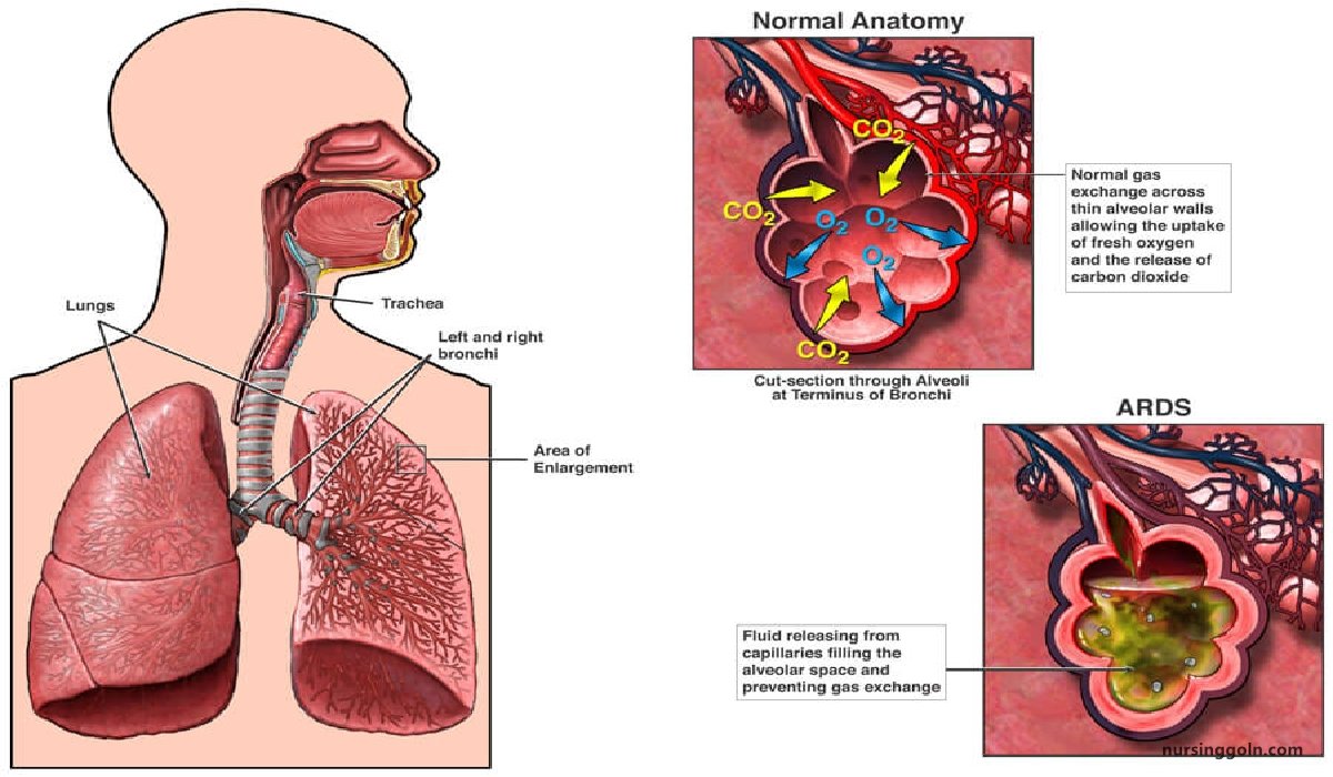 Respiratory distress syndrome (RDS) | CHAPTER 18 | Pediatric Nursing