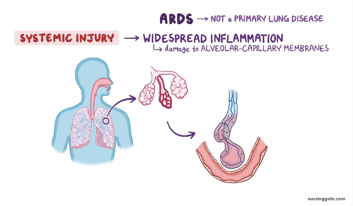 Respiratory distress syndrome (RDS) | CHAPTER 18 | Pediatric Nursing