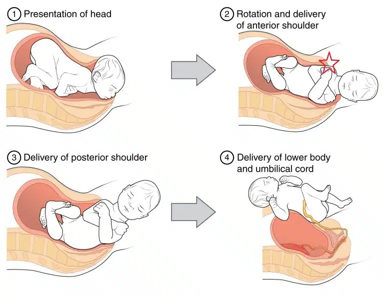 Shoulder dystocia | Chapter 17 | Midwifery For Diploma In Nursing