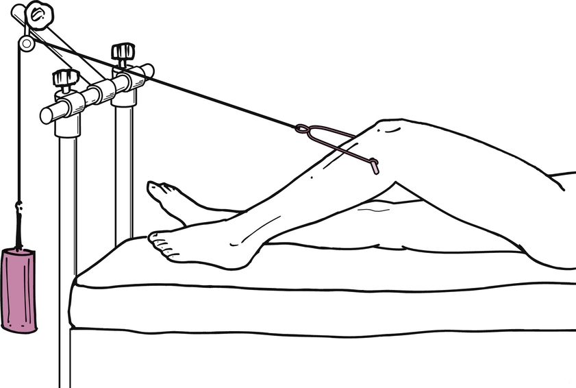 Skeletal Traction | CHAPTER 21 | Orthopedic Nursing