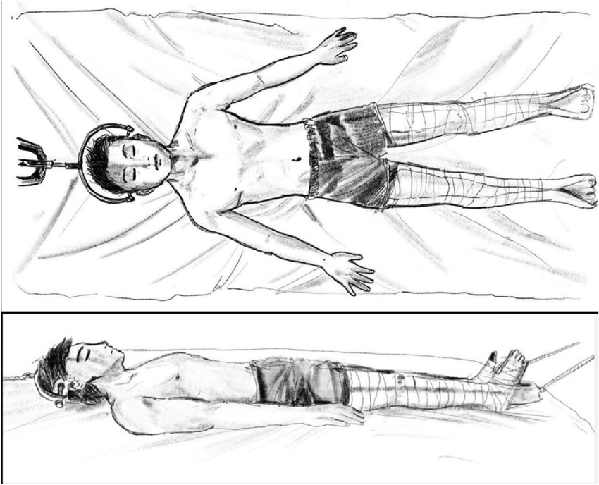 Skull Traction | CHAPTER 21 | Orthopedic Nursing