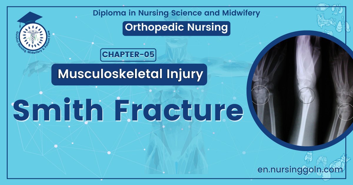 Smith fracture | CHAPTER 5 | Orthopedic Nursing
