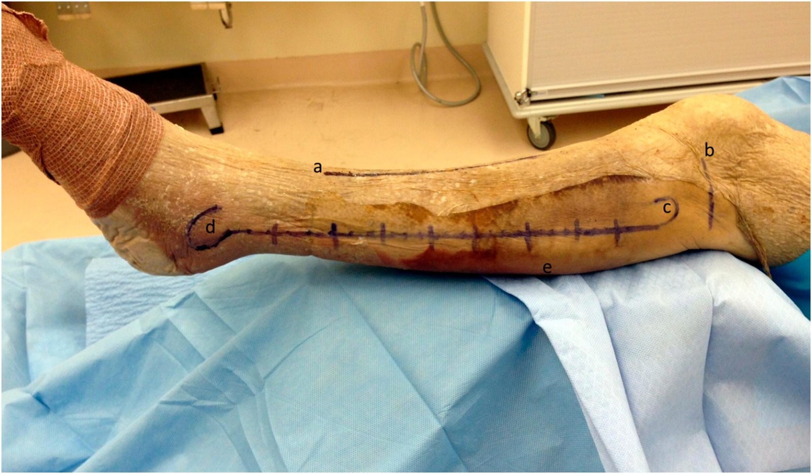 Compartment Syndrome | CHAPTER 22 | Orthopedic Nursing
