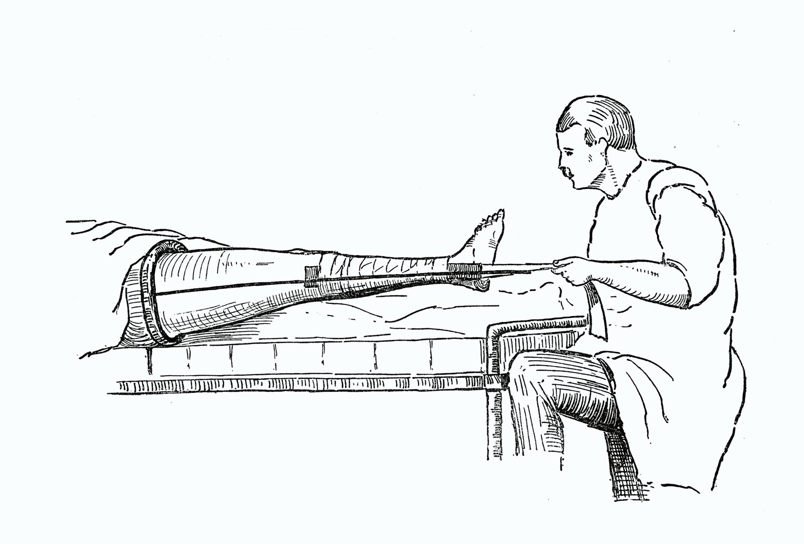 Thomas Splints | CHAPTER 21 | Orthopedic Nursing