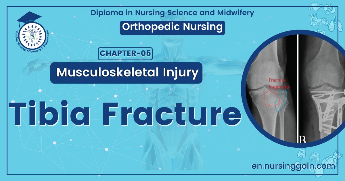 Tibial fracture | CHAPTER 5 | Orthopedic Nursing