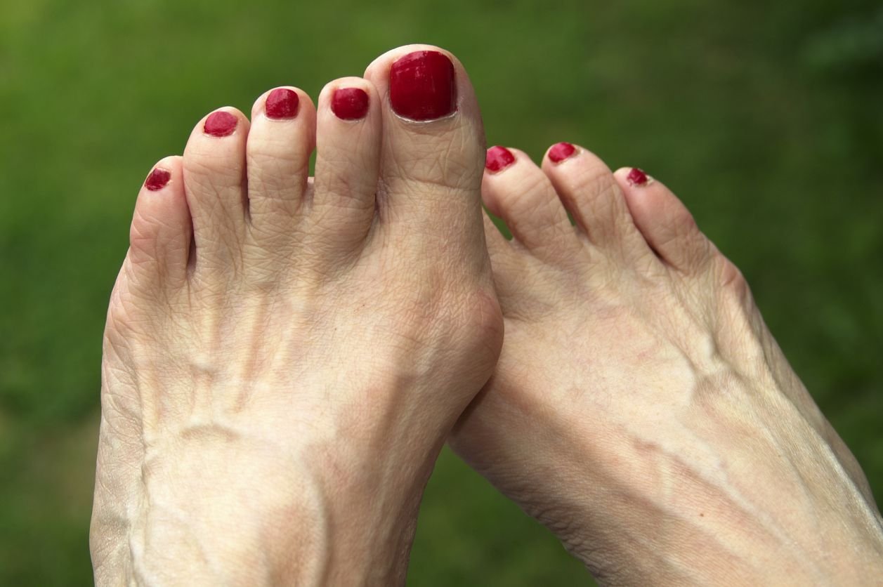 Concept About Club Foot | CHAPTER 20 | Orthopedic Nursing