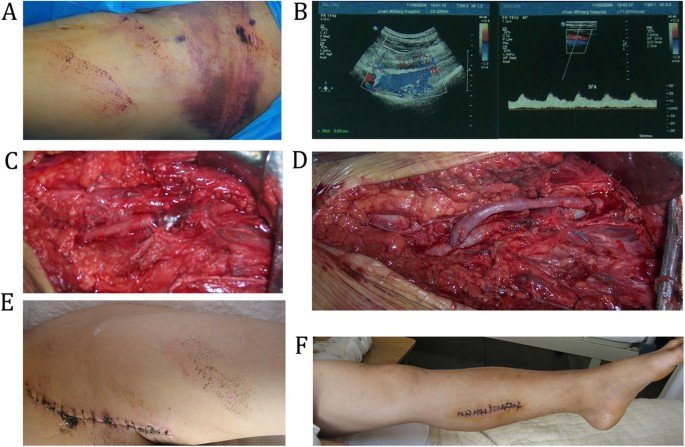 Compartment Syndrome | CHAPTER 22 | Orthopedic Nursing