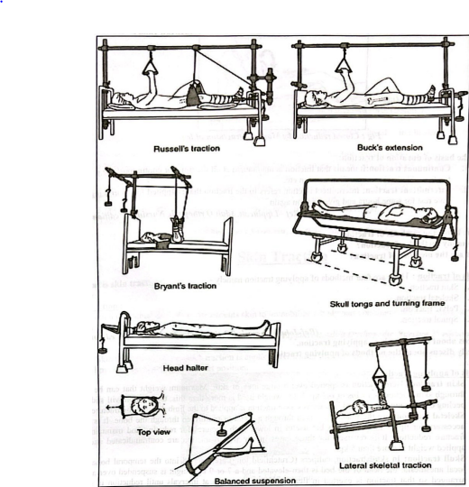 Defination of Traction | CHAPTER 21 | Orthopedic Nursing