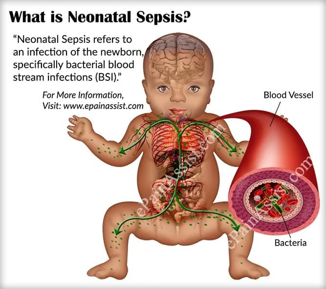 Neonatal sepsis | CHAPTER 18 | Pediatric Nursing