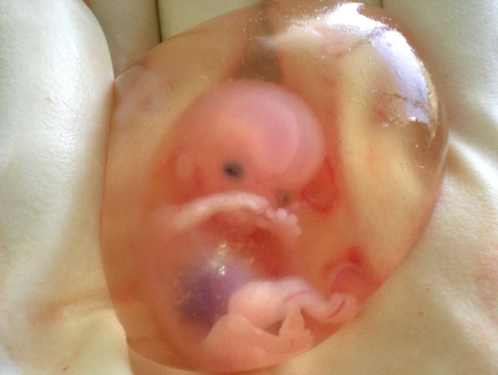 Amniotic fluid 