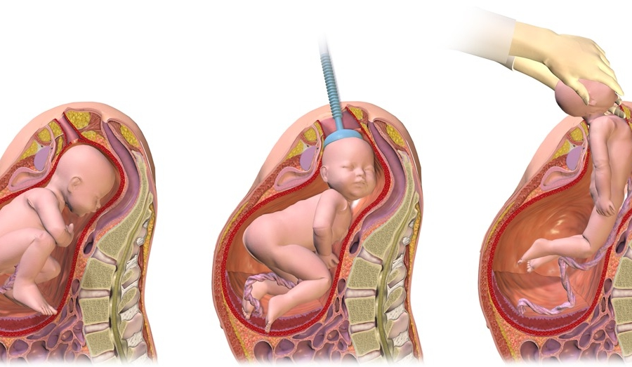 Vacuum extraction/ventouse delivery | Chapter 16 | Midwifery For Diploma In Nursing