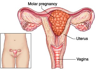 Hydatidiform Mole | Chapter 17 | Midwifery For Diploma In Nursing