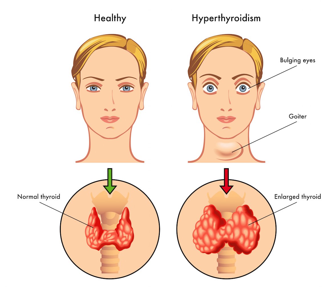 Definition of Hyperthyroidism | Chapter 12 | Midwifery For Diploma In Nursing
