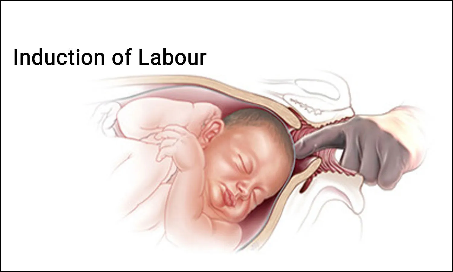 Induction of Labour | Chapter 15 | Midwifery For Diploma In Nursing