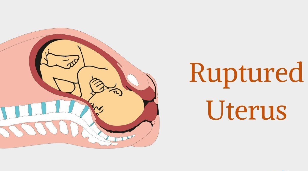 Rupture Uterus | Chapter 17 | Midwifery For Diploma In Nursing