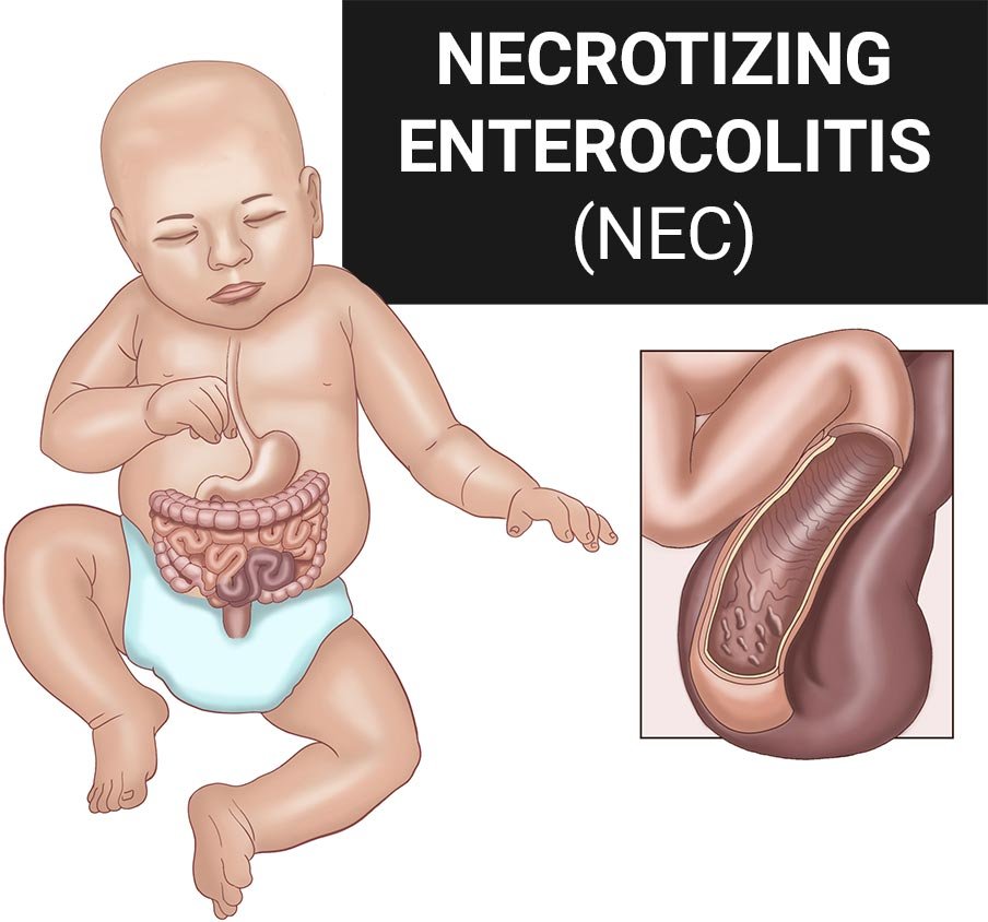 necrotizing enterocolitis