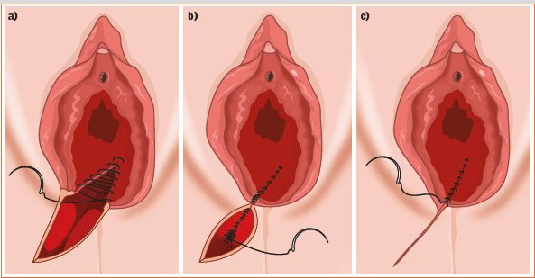 Definition of Episiotomy | Chapter 16 | Midwifery For Diploma In Nursing
