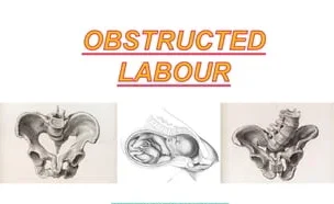 Definition of Obstructed Labour | Chapter 17 | Midwifery For Diploma In Nursing