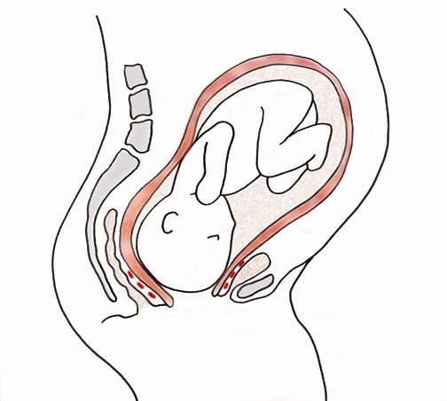 Definition of Obstructed Labour | Chapter 17 | Midwifery For Diploma In Nursing