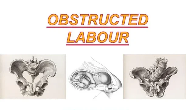Obstructed Labour | Chapter 13 | Midwifery For Diploma In Nursing