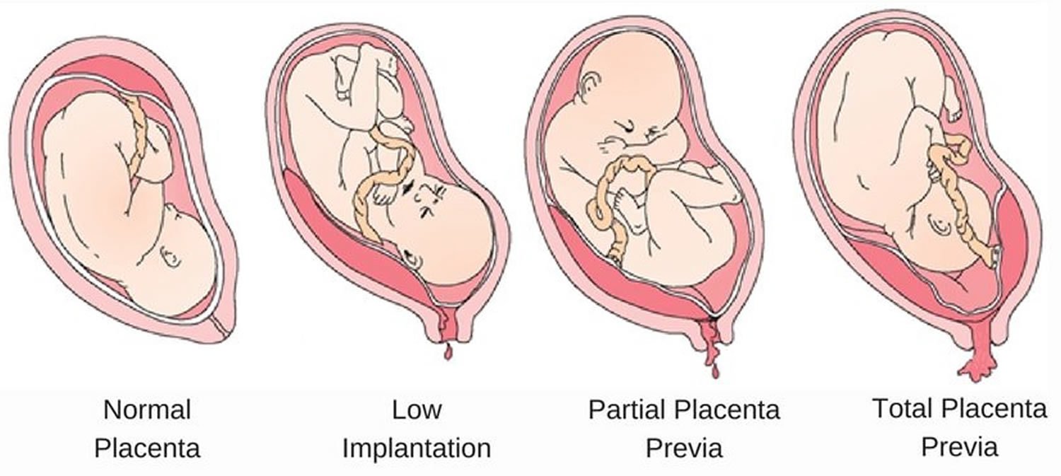 Placenta Praevia | Chapter 11 | Midwifery For Diploma In Nursing