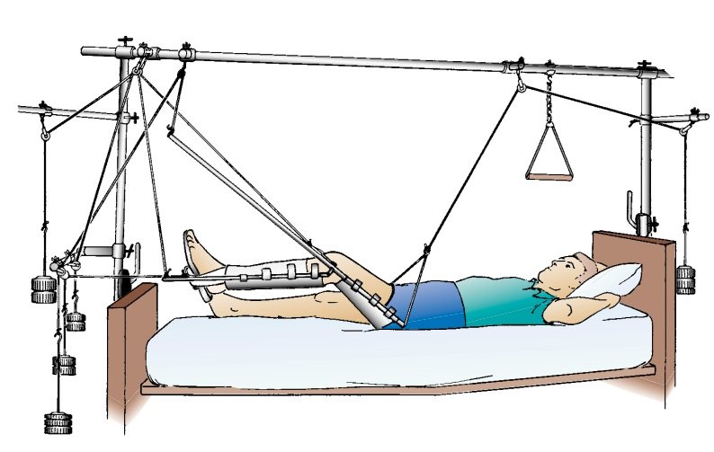 Skeletal Traction | CHAPTER 21 | Orthopedic Nursing