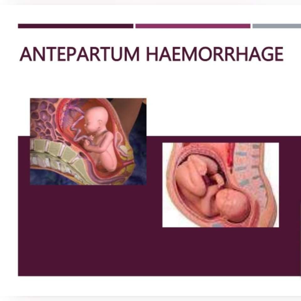 Ante Partum Haemorrhage | Chapter 11 | Midwifery For Diploma In Nursing