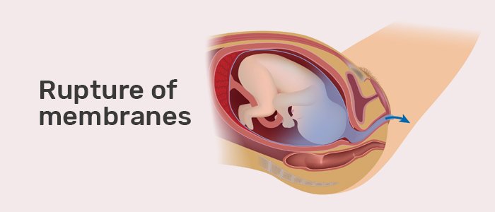 Premature Rupture Of Membrane (PROM) | Chapter 17 | Midwifery For Diploma In Nursing