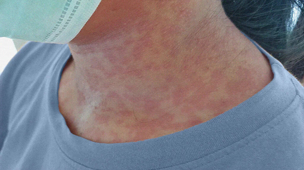 Definition of Rubella | Chapter 12 | Midwifery For Diploma In Nursing