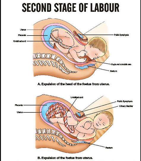 Second Stage Of Labor | Chapter 13 | Midwifery For Diploma In Nursing