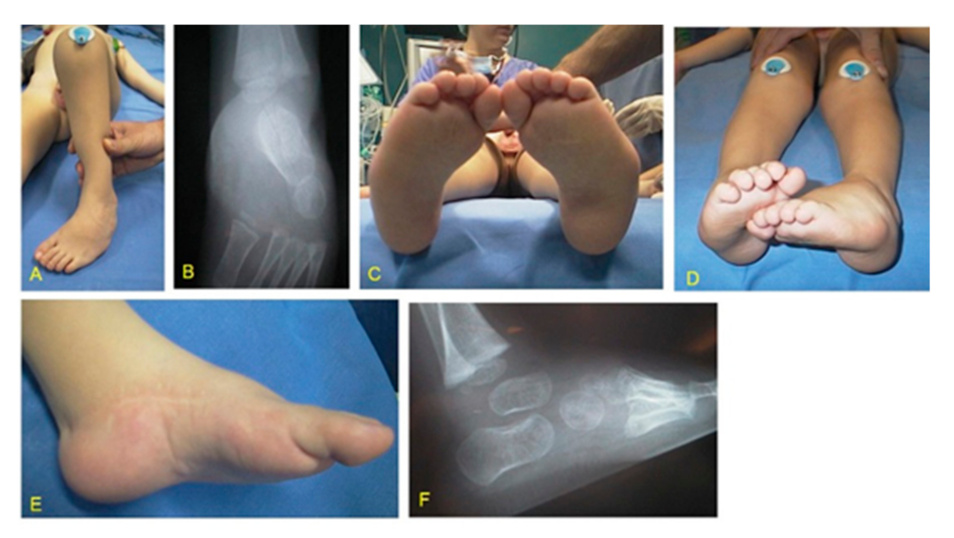 Concept About Club Foot | CHAPTER 20 | Orthopedic Nursing